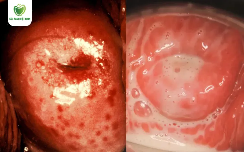 Âm đạo sưng tấy, dịch viêm loãng như sữa là hình ảnh viêm phụ khoa do Trichomonas