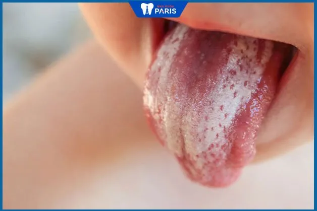 Lưỡi bị bệnh lưỡi trắng do nấm
