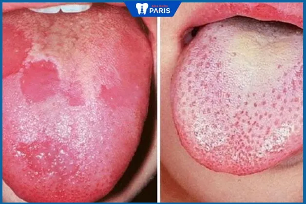 Lưỡi bị bệnh bạch sản