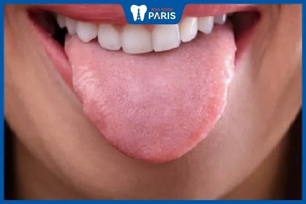 Hình ảnh lưỡi khỏe mạnh điển hình ở người trưởng thành