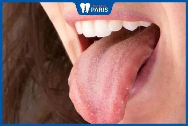 Ảnh chụp lưỡi bình thường tổng thể