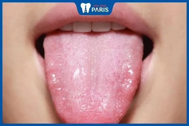 Lưỡi bình thường có hình dạng thon dài, mềm mại