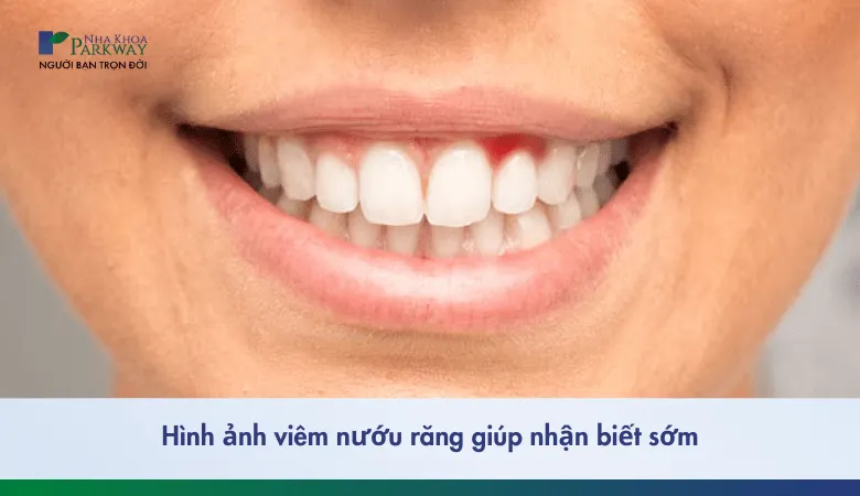 Hình ảnh sưng nướu răng đỏ tấy, dấu hiệu viêm nhiễm