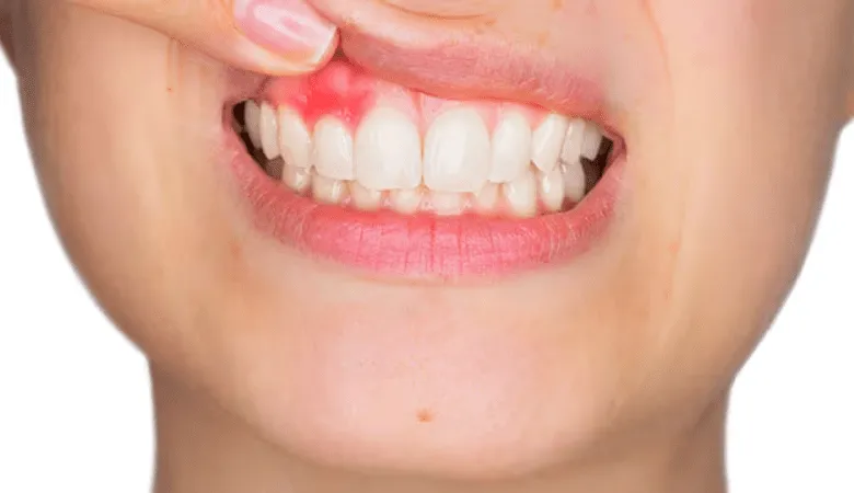 Hình ảnh nướu răng bị sưng và viêm
