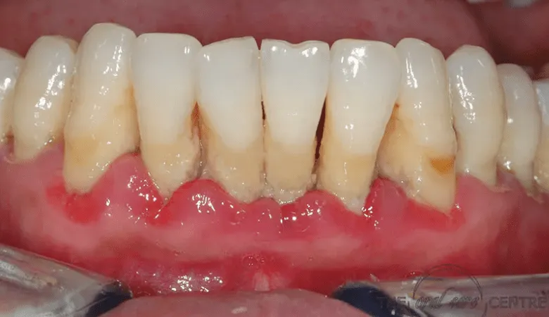 Nướu bị tụt khỏi chân răng do viêm