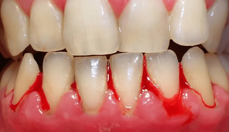 Tình trạng chảy máu chân răng do sưng nướu