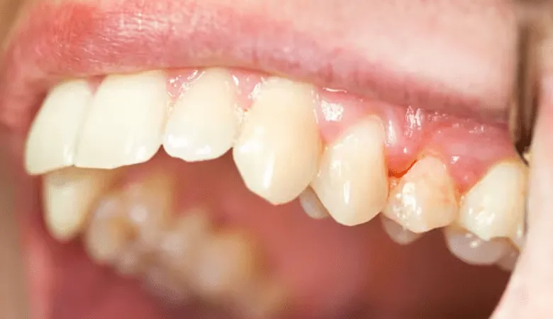 Hình ảnh nướu sưng đỏ và dễ chảy máu