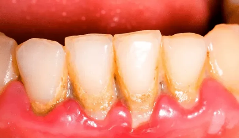 Hình ảnh nướu sưng đỏ và dễ chảy máu