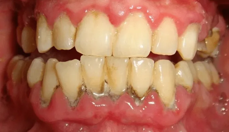 Cao răng tích tụ gây sưng viêm nướu