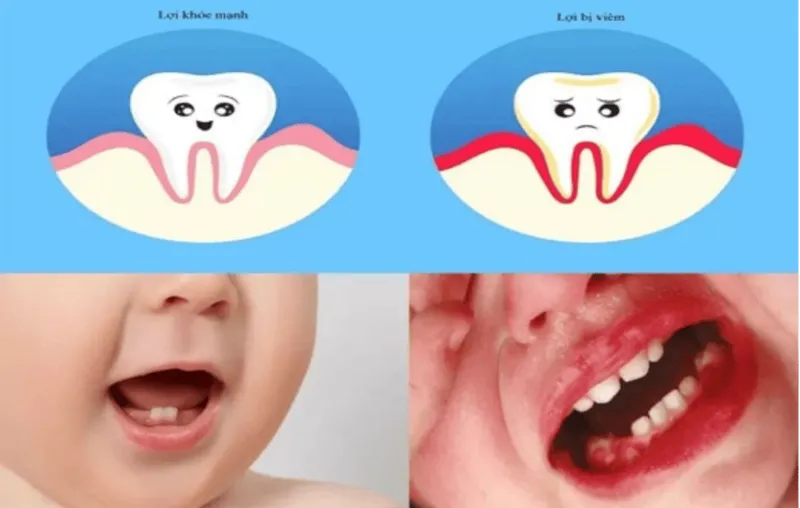 Hình ảnh nướu răng bị sưng đỏ ở trẻ gây khó chịu khi ăn uống.