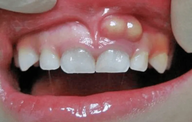 Vệ sinh răng miệng kém dẫn đến mảng bám và viêm nướu ở trẻ em.