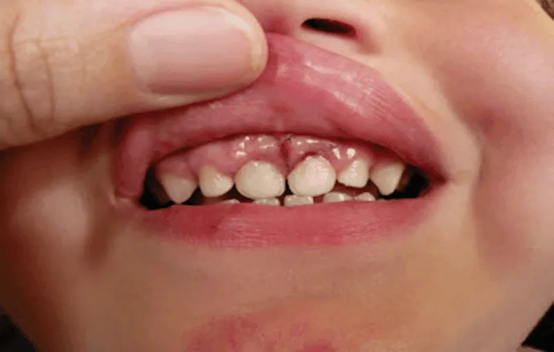 Phụ huynh cần quan sát hình ảnh nướu răng của trẻ để phát hiện sớm viêm nhiễm.