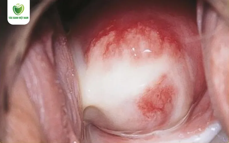 Hình ảnh viêm phụ khoa do Chlamydia với dịch tiết bất thường
