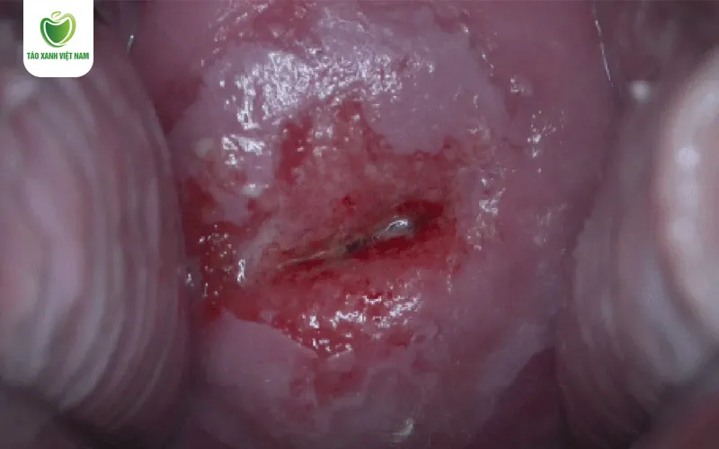 Hình ảnh viêm phụ khoa do HPV với các nốt sùi