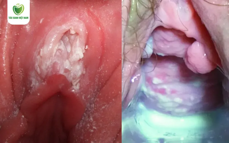 Hình ảnh viêm phụ khoa do nấm thường có khí hư trắng đục như bã đậu