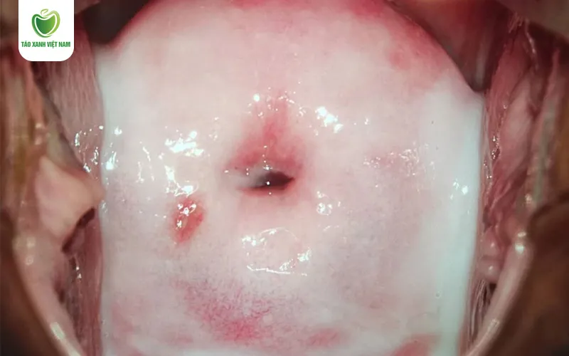 Khí hư bất thường, có mùi tanh là hình ảnh viêm phụ khoa do vi khuẩn