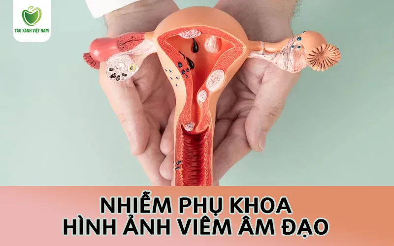 Phụ nữ cần nhận biết sớm hình ảnh viêm phụ khoa để bảo vệ sức khỏe
