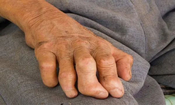 Thời gian ủ bệnh của bệnh phong cùi có thể kéo dài nhiều năm trước khi phát bệnh