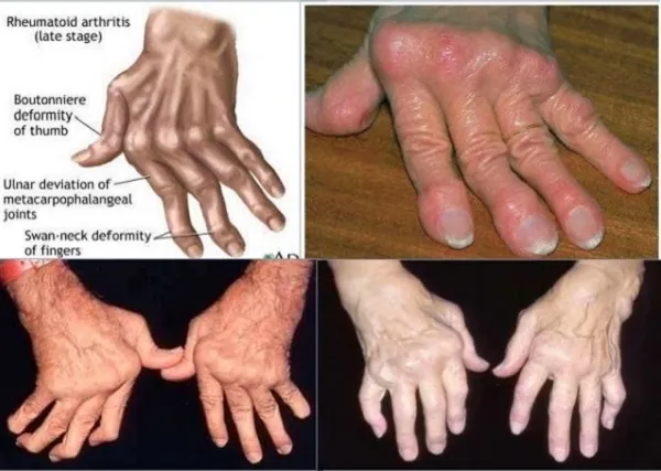 Tổng quan các triệu chứng điển hình của bệnh phong cùi trên cơ thể người bệnh