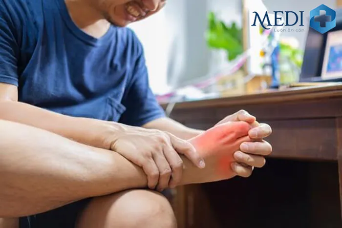 Mu bàn chân sưng đỏ là hình ảnh thường gặp ở người bị viêm khớp