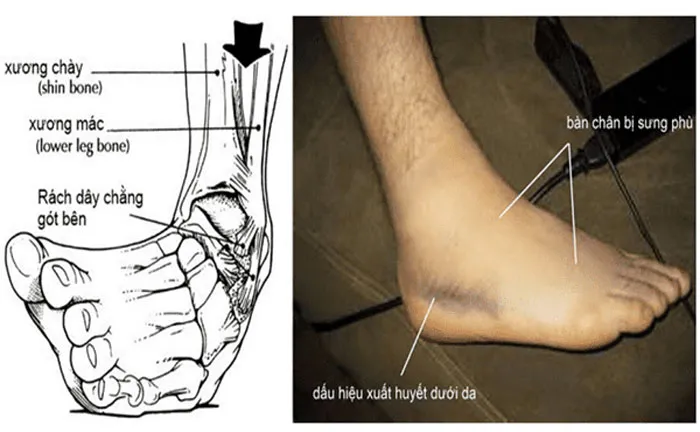 Hình ảnh mu bàn chân bị trật khớp gây đau nhức và hạn chế vận động